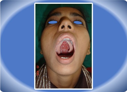 CLEFT PALATE